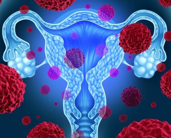 Você sabe o que fazer para evitar o câncer de colo de útero?